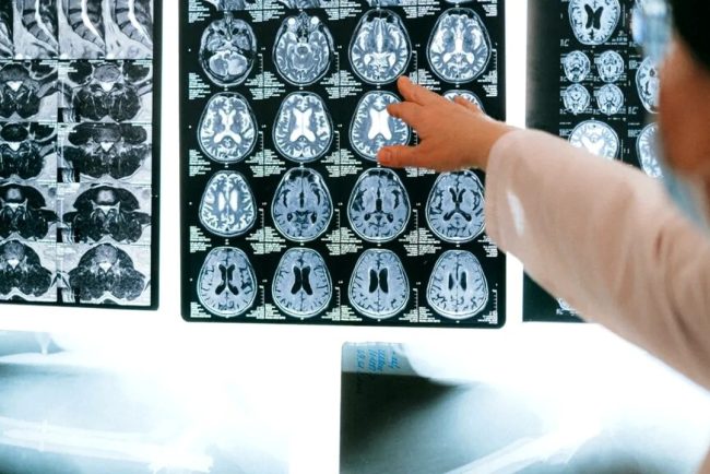 Descoperire in neurostiinte un cercetator german dezvaluie modul in care functioneaza sistemul de navigatie al creierului uman