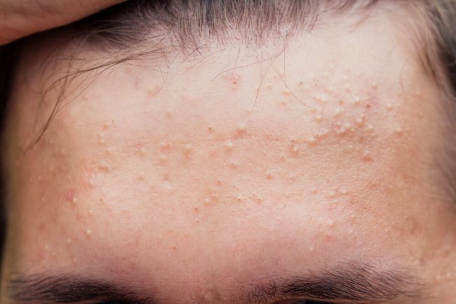 acid salicilic pentru acnee ghid complet in 3 pasi
