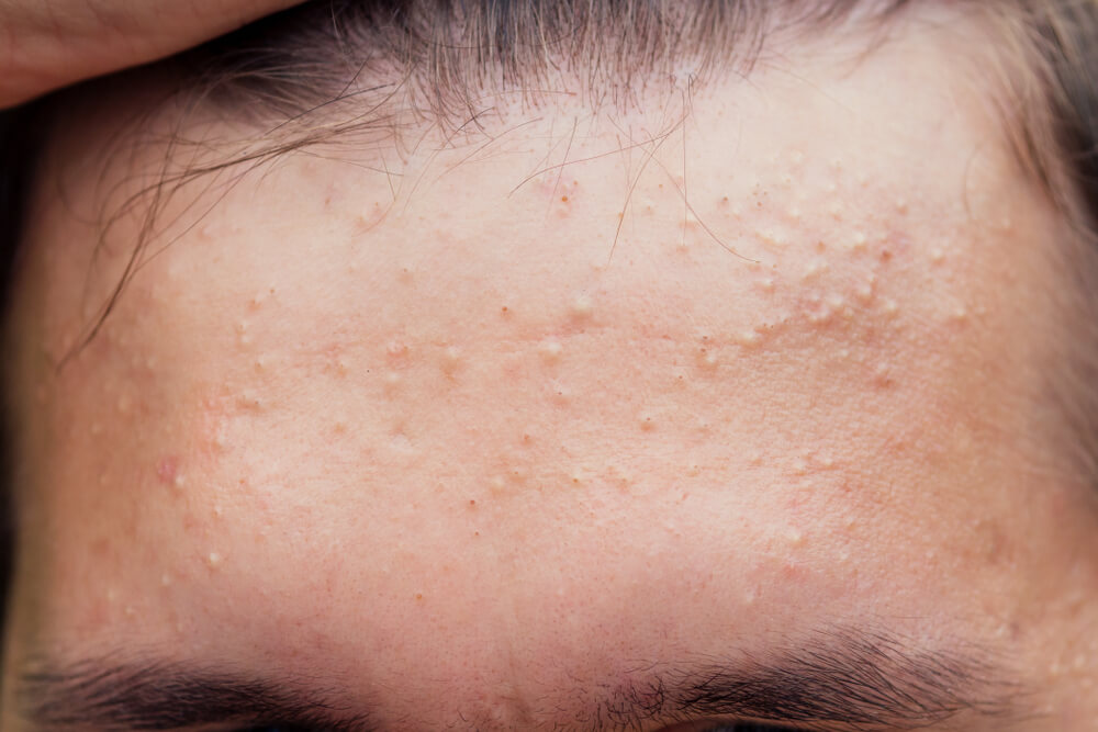 acid salicilic pentru acnee ghid complet in 3 pasi