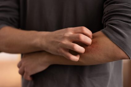 Înțepăturile de insecte: cum să le identifici, ce măsuri să iei și când să ceri ajutor medical de urgență.